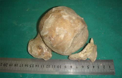 The biggest kidney stone